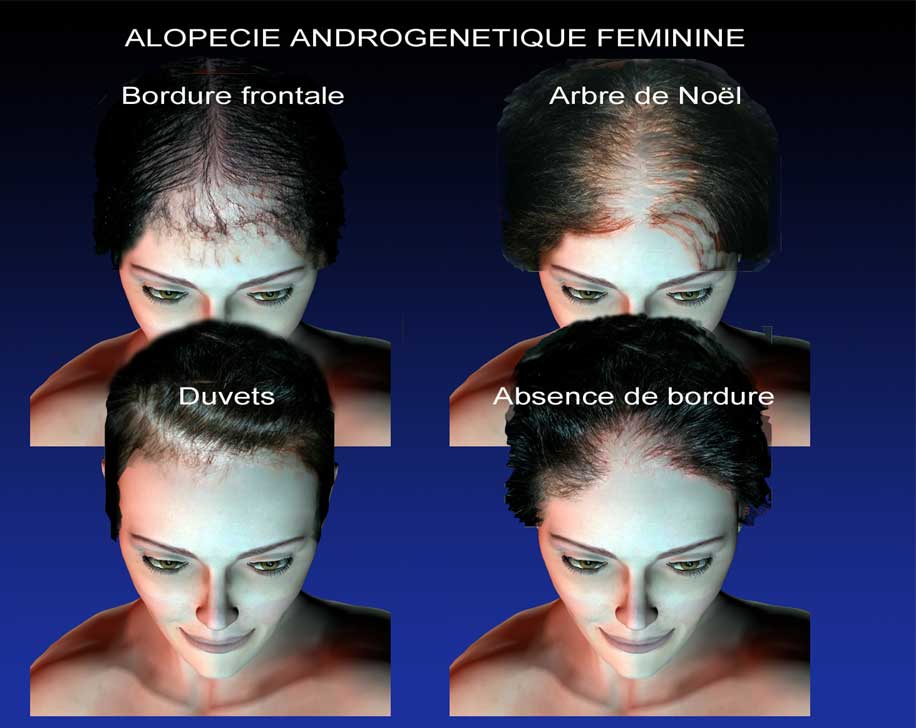 Androcur contre aldactone