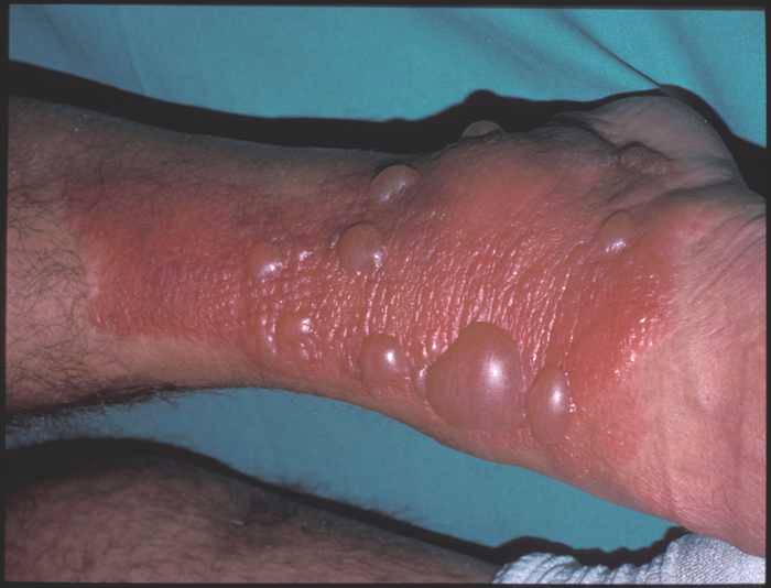 Les boutons dans le bas du visage sur les joues