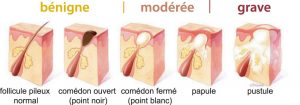 acne-differents-stades-extrait-net
