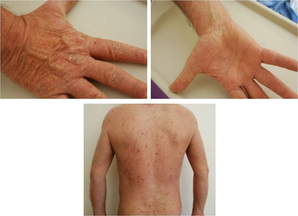 GALE : Une épidémie europeenne . Dr Hervé VAN LANDUYT Besancon Asfoder