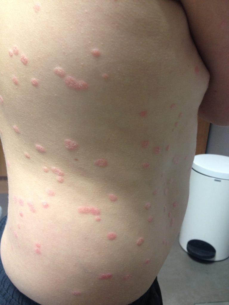 Psoriasis Une dermatose fréquente Dr Hervé VAN LANDUYT Asfoder ...