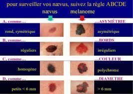 FRANC COMTOIS Protège toi, Surveille toi. POUR SAUVER TA PEAU : SURVEILLE TA PEAU. Autoexamen tout seul ou en couple  Posté Dr Hervé VAN LANDUYT  Asfoder 2022